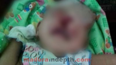 Lahir Dengan Wajah Tak Normal, Mohammad Ali Harus Jalani Operasi Plastik