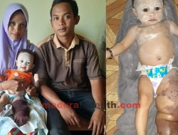 Sejak Usia 10 Hari Nanda Nur Anisa Maharani Mengidap Lymphangioma