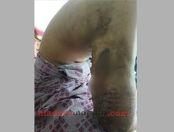 Irham Maulana, Pengidap Kanker di Pamekasan Butuh Bantuan Biaya