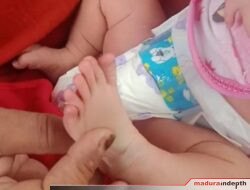 Bayi Perempuan di Sampang Lahir Dengan 24 Jari di Tangan dan Kaki